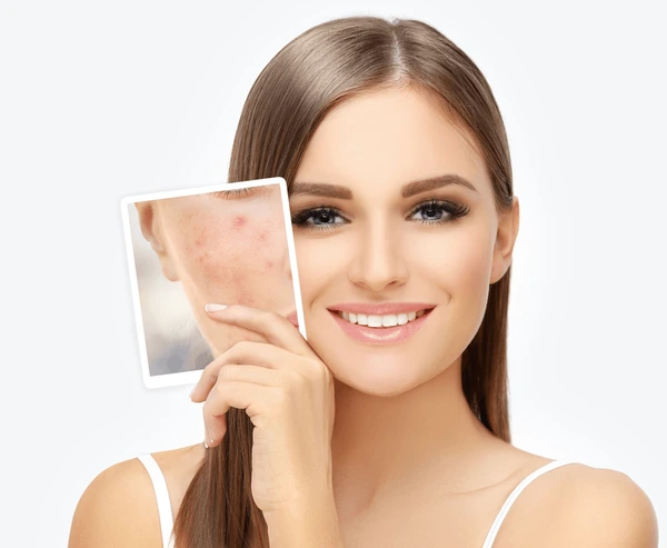 Acne Treatments